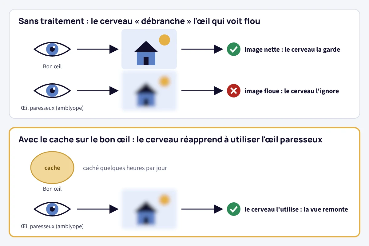 Schéma de l'amblyopie : sans traitement, le cerveau garde l'image nette du bon œil et ignore l'image floue de l'œil paresseux ; avec un cache sur le bon œil, le cerveau réapprend à utiliser l'œil paresseux