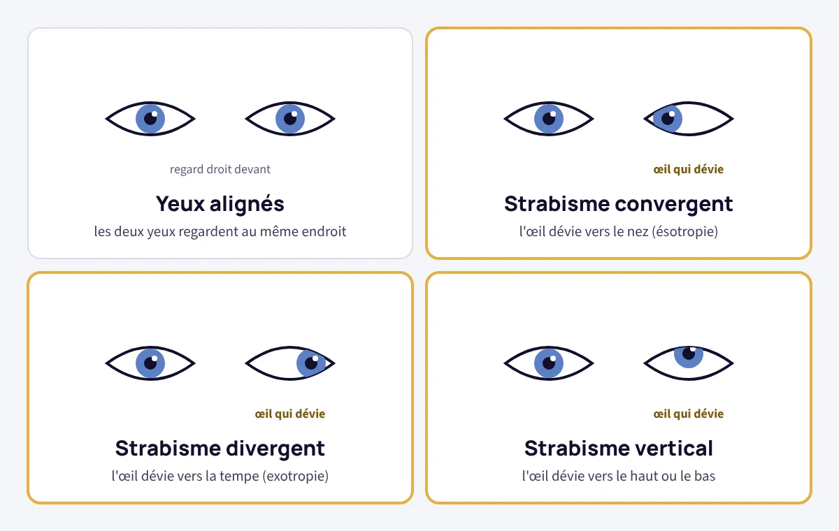 Schéma des types de strabisme de l'enfant : yeux alignés, strabisme convergent (œil vers le nez), divergent (œil vers la tempe) et vertical
